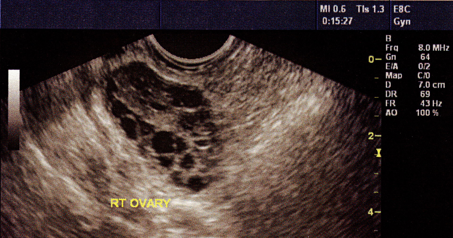 Högt insulin – orsak till PCOS och utebliven ägglossning